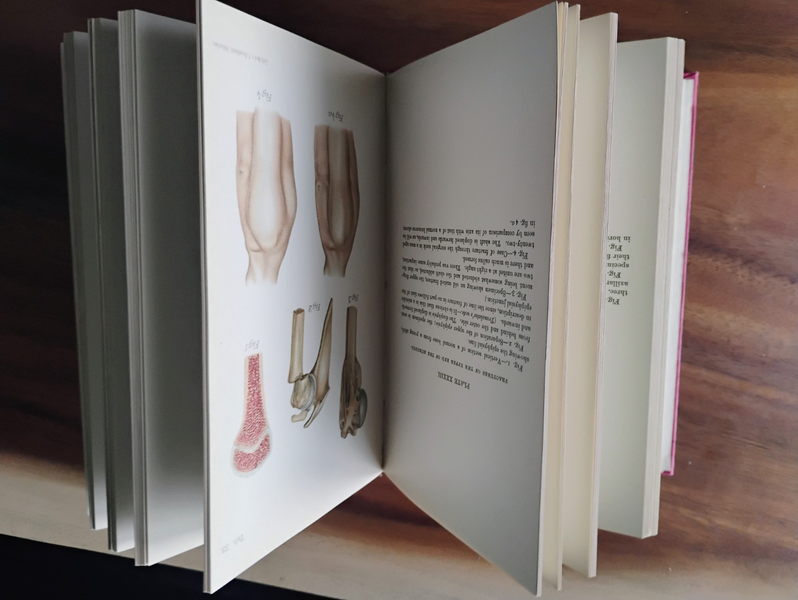 1899 On Fractures and Luxations by H. Helferich – AMAZING condition, like new!